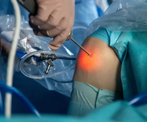Arthroscopy Surgery