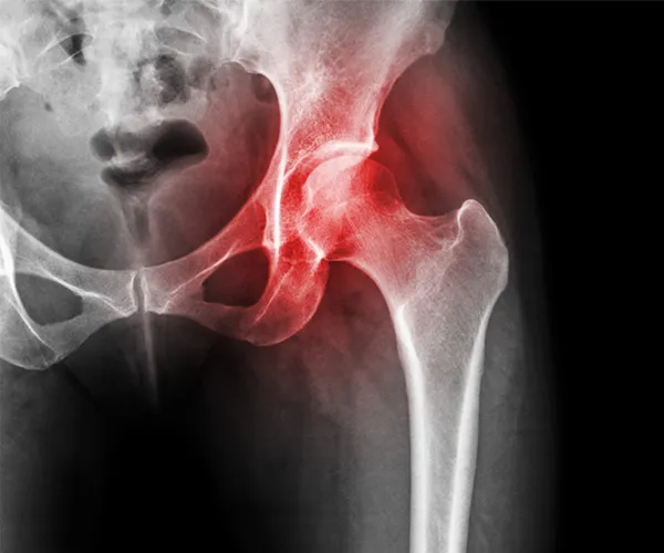 Avascular Necrosis Treatment in Jammu and Kashmir