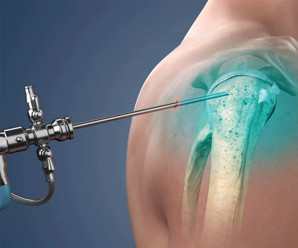Advanced Shoulder Replacement Technology in India