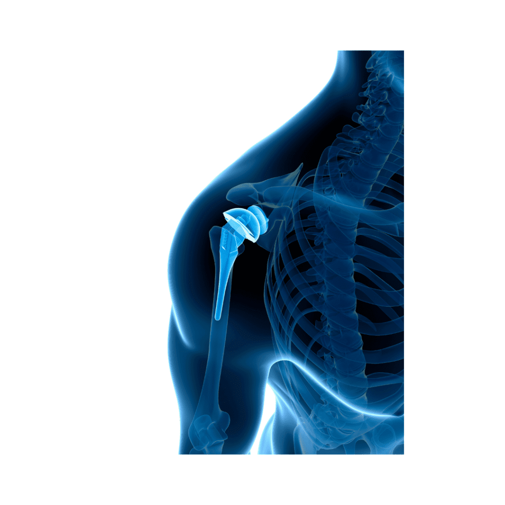 Shoulder Replacement Near Me