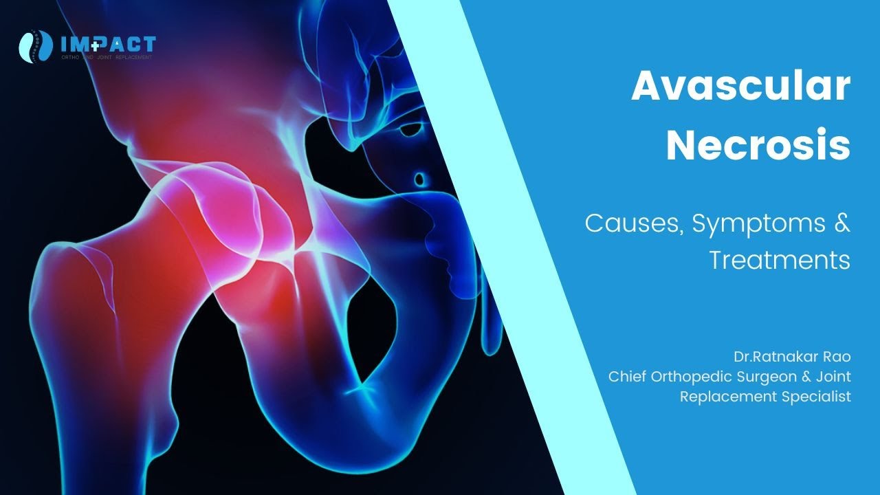 AVN & Joint pains - Causes, Symptoms & Treatments by Dr. Ratnakar Rao, Orthopedic Surgeon, Hyderabad
